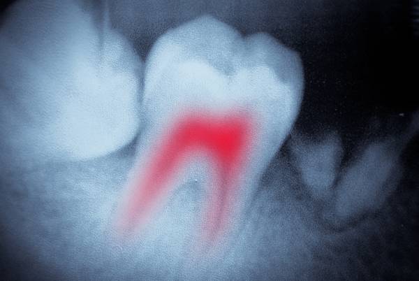 An x-ray highlighting the root of a tooth in red