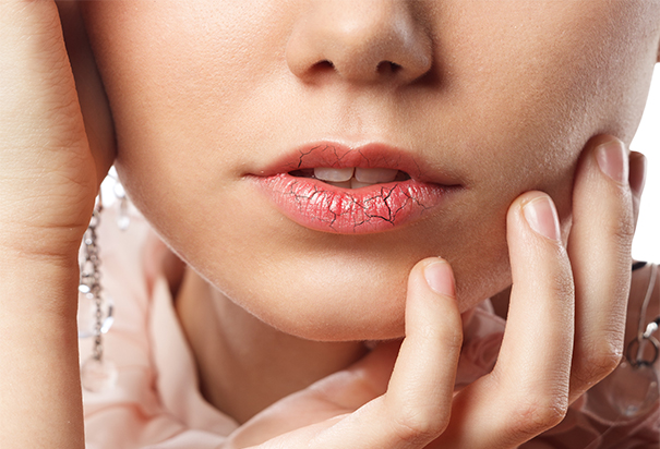 Closeup of woman with severely chapped lips, wondering what causes dry mouth
