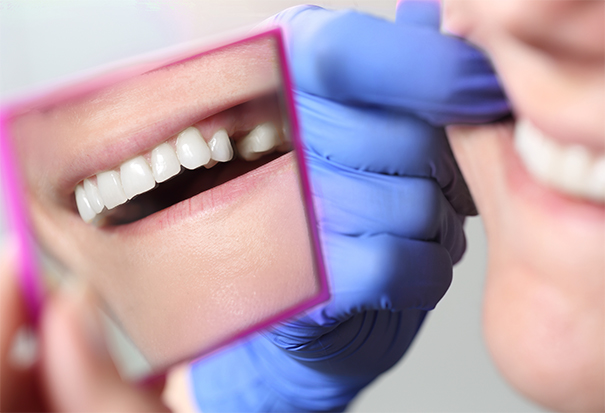 Dental patient examining gap between teeth in a mirror.