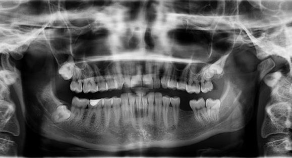Panoramic x-ray of mouth missing a tooth