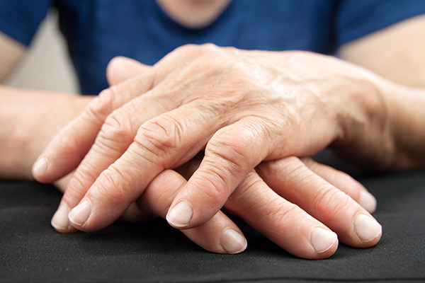 Hands of a woman with rheumatoid arthritis