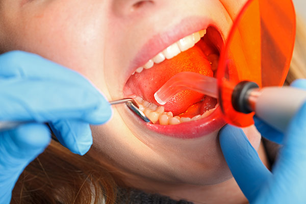 Woman at the dentist with a curing light in her mouth.