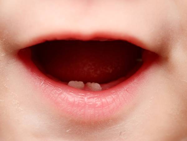 The bottom two front teeth are usually the first ones to erupt through the gums when you have a teething baby.