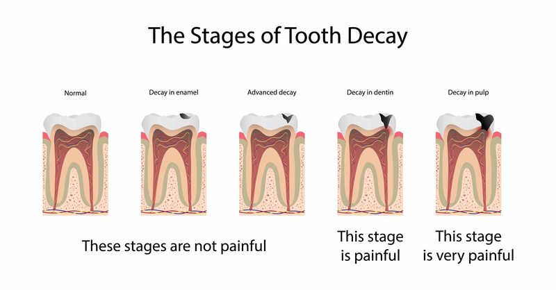 Progression of tooth decay from a white spot lesion to a dark cavity with a visible hole